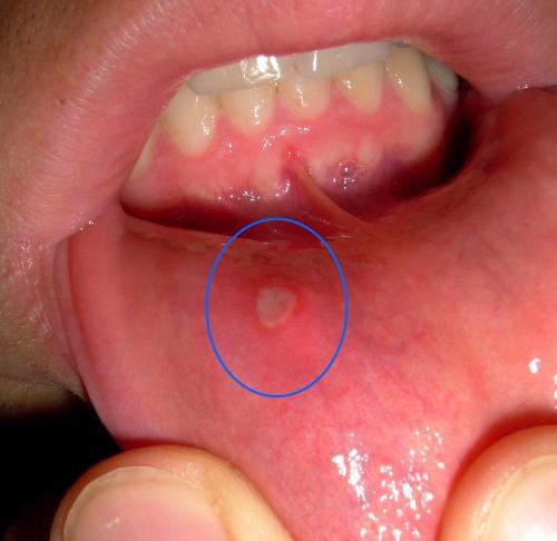 Loét miệng ở trẻ em – Nguyên nhân gây bệnh là gì?